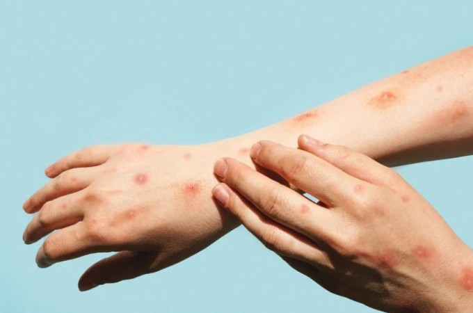 Araraquara registrou 1� caso da doen�a mpox